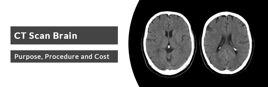 CT Scan Brain: Purpose, Procedure, Cost in Delhi/ Noida/ NCR